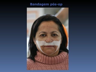 Bandagem pós-op
 