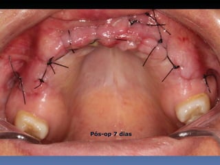 Pós-op 7 dias
 