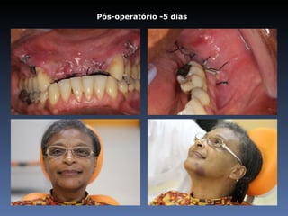 Pós-operatório -5 dias
 