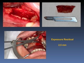 Espessura Residual

     2,5 mm
 