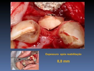 Espessura após reabilitação

        8,8 mm
 