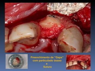 Preenchimento de “Gaps”
 com particulado ósseo
           e
         Sutura
 