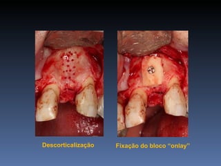 Descorticalização   Fixação do bloco “onlay”
 