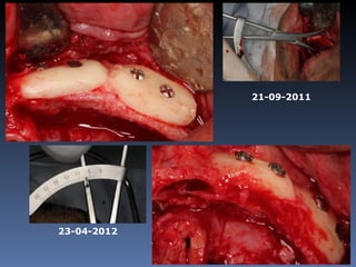 21-09-2011
              Zona 2.3
              3,5 mm
                          21-09-2011




23-04-2012
 