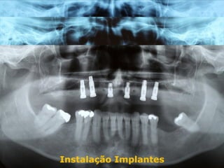 Pré reabilitação
 Reabilitação Aloenxerto
Instalação Implantes
 