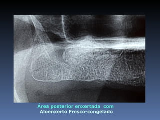 Área posterior enxertada com
 Aloenxerto Fresco-congelado
 