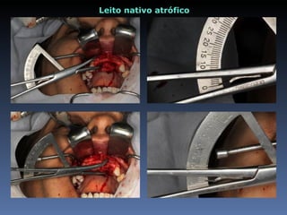 Leito nativo atrófico
 