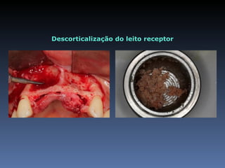 Descorticalização do leito receptor
 