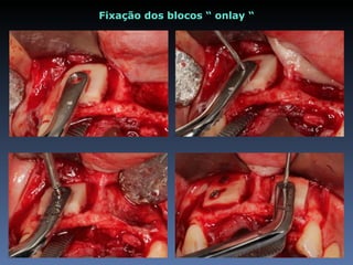 Fixação dos blocos “ onlay “
 
