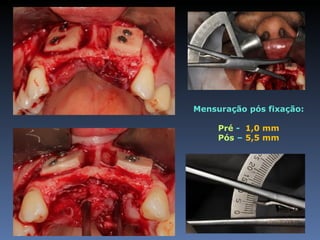 Mensuração pós fixação:

     Pré - 1,0 mm
     Pós – 5,5 mm
 