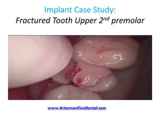 Implant Case Study:
Fractured Tooth Upper 2nd premolar




        www.ArtarmonFineDental.com
 