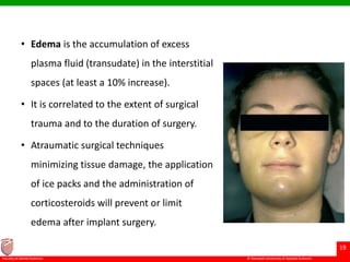 © Ramaiah University of Applied Sciences
19
Faculty of Dental Sciences
• Edema is the accumulation of excess
plasma fluid (transudate) in the interstitial
spaces (at least a 10% increase).
• It is correlated to the extent of surgical
trauma and to the duration of surgery.
• Atraumatic surgical techniques
minimizing tissue damage, the application
of ice packs and the administration of
corticosteroids will prevent or limit
edema after implant surgery.
 