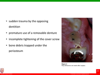 © Ramaiah University of Applied Sciences
21
Faculty of Dental Sciences
• sudden trauma by the opposing
dentition
• premature use of a removable denture
• incomplete tightening of the cover screw
• bone debris trapped under the
periosteum
 
