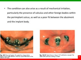 © Ramaiah University of Applied Sciences
50
Faculty of Dental Sciences
• The condition can also arise as a result of mechanical irritation,
particularly the presence of calculus and other foreign bodies within
the periimplant sulcus, as well as a poor fit between the abutment
and the implant body.
 