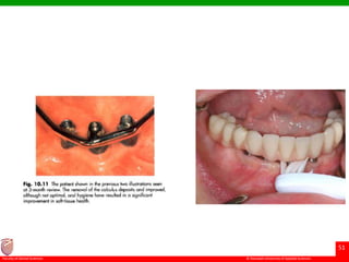 © Ramaiah University of Applied Sciences
51
Faculty of Dental Sciences
 
