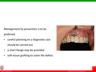 © Ramaiah University of Applied Sciences
57
Faculty of Dental Sciences
Management by prevention is to be
preferred
• careful planning on a diagnostic cast
should be carried out.
• a short flange may be provided
• soft-tissue grafting to cover the defect.
 