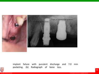 © Ramaiah University of Applied Sciences
59
Faculty of Dental Sciences
implant failure with purulent discharge and 7.0 mm
pocketing. (b) Radiograph of bone loss.
 