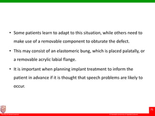 © Ramaiah University of Applied Sciences
75
Faculty of Dental Sciences
• Some patients learn to adapt to this situation, while others need to
make use of a removable component to obturate the defect.
• This may consist of an elastomeric bung, which is placed palatally, or
a removable acrylic labial flange.
• It is important when planning implant treatment to inform the
patient in advance if it is thought that speech problems are likely to
occur.
 