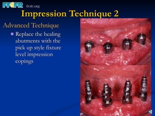 Impression Technique 2 Advanced Technique Replace the healing abutments with the pick up style fixture level impression copings 