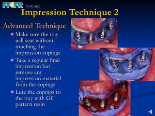 Impression Technique 2 Advanced Technique Make sure the tray will seat without touching the impression copings Take a regular final impression but remove any impression material from the copings Lute the copings to the tray with GC pattern resin 