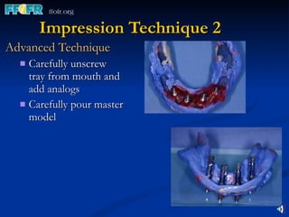 Impression Technique 2 Advanced Technique Carefully unscrew tray from mouth and add analogs  Carefully pour master model 