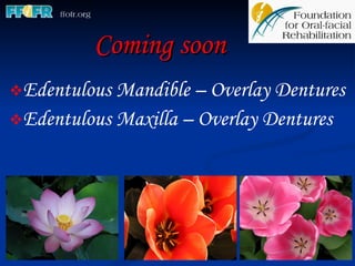 Coming soon Edentulous Mandible – Overlay Dentures Edentulous Maxilla – Overlay Dentures 