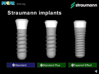 Straumann implants Standard Plus Standard Tapered Effect 