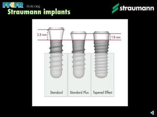 Straumann implants 