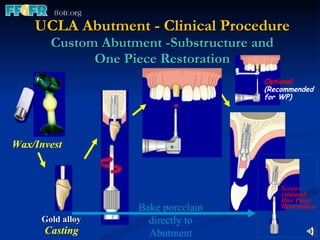 UCLA Abutment - Clinical Procedure Custom Abutment -Substructure and One Piece Restoration Bake porcelain directly to Abutment Wax/Invest Gold alloy Casting Optional (Recommended for WP) Screw-retained- One Piece Restoration 