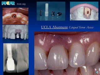 UCLA Abutment :  Lingual Screw Access 