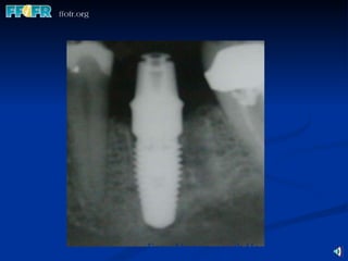Easy Abutment with Healing Cap 