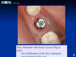 Easy Abutment with Screw Access Plug in place - No modification of the  Easy  Abutment  was required   in this case. 