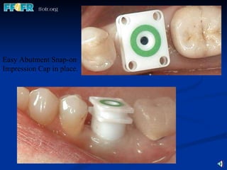 Easy Abutment Snap-on  Impression Cap in place. 