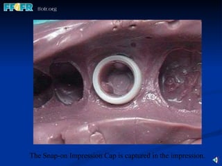 The Snap-on Impression Cap is captured in the impression. 