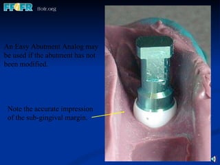 An Easy Abutment Analog may be used if the abutment has not been modified. Note the accurate impression of the sub-gingival margin. 