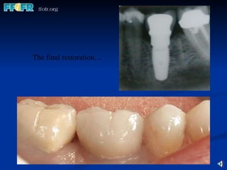 The final restoration… 