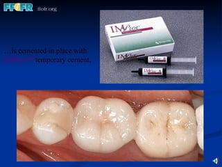 … is cemented in place with   ImProv ™   temporary cement. 