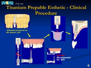 Titanium Prepable Esthetic - Clinical Procedure Abutment prepared on the master cast Optional (Recommended for WP) 