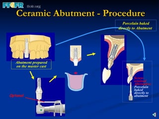 Ceramic Abutment - Procedure Porcelain baked directly to Abutment   Abutment prepared on the master cast Optional Screw-retained Alternative: Porcelain baked directly to abutment 