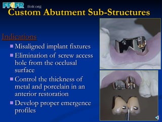 Custom Abutment Sub-Structures Indications   Misaligned implant fixtures Elimination of screw access hole from the occlusal surface Control the thickness of metal and porcelain in an anterior restoration Develop proper emergence profiles 