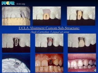 UCLA Abutment Custom Sub-Structure:   Angle Correction- Lingual set screw 