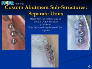 Custom Abutment Sub-Structures: Separate Units Begin with full contour wax-up using a UCLA abutment (AuAdapt).  Note the buccal angulation of the implants. 