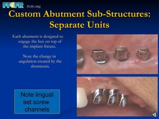Custom Abutment Sub-Structures: Separate Units Each abutment is designed to engage the hex on top of the implant fixture.  Note the change in angulation created by the abutments. Note lingual set screw  channels 