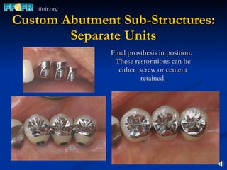 Custom Abutment Sub-Structures: Separate Units Final prosthesis in position.  These restorations can be either  screw or cement retained. 