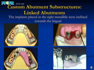Custom Abutment Substructures: Linked Abutments The implants placed in the right mandible were inclined towards the lingual 
