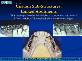 Custom Sub-Structures: Linked Abutments This technique permits the clinician to control two key occlusal factors – width of the occlusal table, and the cusp angles.  Result: Reduced load magnification and less chance of implant overload. 
