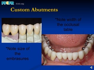 Custom Abutments *Note size of the embrasures *Note width of the occlusal table 