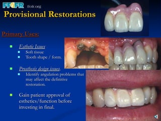Primary Uses: Esthetic Issues Soft tissue  Tooth shape / form. Prosthesis design issues . Identify angulation problems that may affect the definitive restoration. Gain patient approval of esthetics/function before investing in final. Provisional Restorations 