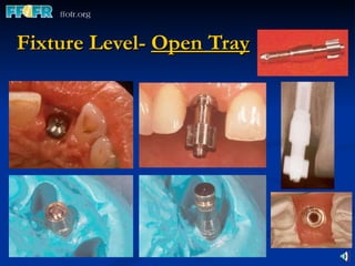 Fixture Level-  Open Tray 