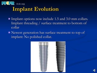Implant Evolution Implant options now include 1.5 and 3.0 mm collars. Implant threading / surface treatment to bottom of collar Newest generation has surface treatment to top of implant: No polished collar. 